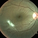 Epiretinal Membrane Epiretinal Membrane