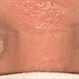Fuchs' Heterochromic iridocyclitis Fuchs' Heterochromic iridocyclitis