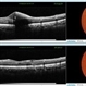 Sub-Internal Limiting Membrane Hemorrhage - Pre and Post YAG Laser Sub-Internal Limiting Membrane Hemorrhage - Pre and Post YAG Laser