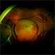 Optos Silverstone Fundus Image of a 4-Point Scleral Fixation Akreos AO60 with Gore Tex Suture Optos Silverstone Fundus Image of a 4-Point Scleral Fixation Akreos AO60 with Gore Tex Suture