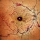 Central Retinal Vein Occlusion with Foveal Hemorrhage Central Retinal Vein Occlusion with Foveal Hemorrhage