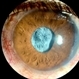 Wrinkled Anterior Capsule 16X zoom
