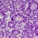 Retinoblastoma