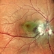 Dengue Maculopathy Acute Phase Dengue Maculopathy Acute Phase