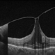 Vitreomacular Adhesion Showcasing a Microaneurysm and a Subhyaloid Hemorrhage Vitreomacular Adhesion Showcasing a Microaneurysm and a Subhyaloid Hemorrhage