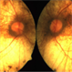 Choroideremia