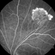 Sea Fan Neovascularisation Sea Fan Neovascularisation
