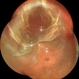 RHEGMATOGENOUS RETINAL DETACHMENT