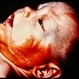 Skin Photo of Linear Nevus Sebaceous Syndrome