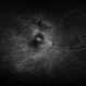 VKH Pseudotumor – Fluorescein Angiography VKH Pseudotumor – Fluorescein Angiography