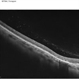 OCT Choroidal Rupture