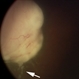 Retinoblastoma with Vitreous Seeding Retinoblastoma with Vitreous Seeding