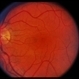 Congenital Disc Anomaly Congenital Disc Anomaly