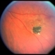 Intraocular Foreign Body Intraocular Foreign Body