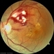 Hypertensive Retinopathy Grade IV Hypertensive Retinopathy Grade IV