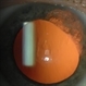 Iris transillumination in a patient with herpetic iritis