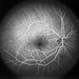 Branch Retinal Vein Occlusion Branch Retinal Vein Occlusion