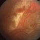 AIDS and CMV Retinitis AIDS and CMV Retinitis