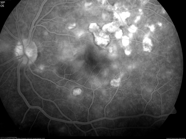 APMPPE in a 21-Year-Old Female Patient - Retina Image Bank