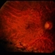 Angioma from Chronic Retinal Detachment Angioma from Chronic Retinal Detachment