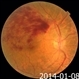 Recurrent Branch Retinal Vein Occlusion Recurrent Branch Retinal Vein Occlusion