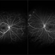 Sickle Cell Disease Retinopathy Sickle Cell Disease Retinopathy