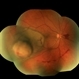 Collar Button Choroidal Melanoma Collar Button Choroidal Melanoma