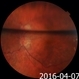 Gas-Filled Eye Gas-Filled Eye