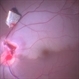 Intraocular Foreign Body with BRAO Intraocular Foreign Body with BRAO