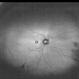 Cone Dystrophy Cone Dystrophy