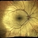 Oguchi Disease OD Oguchi Disease OD