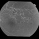 BRVO With Non-Perfusion
