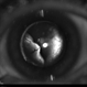 Total Rhegmatogenous and Tractional Retinal Detachment Following  Choroidal Melanoma Laser Ablation Treatment
