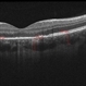 05- Unilateral Acute Idiopathic Maculopathy (UAIM) - OCT OD2 05- Unilateral Acute Idiopathic Maculopathy (UAIM) - OCT OD2