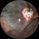 Rhegmatogenous retinal detachment with dislocated IOL in a Morning Glory anomaly Rhegmatogenous retinal detachment with dislocated IOL in a Morning Glory anomaly