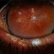Repaired Retinal Detachment Repaired Retinal Detachment