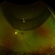 Chronic Retinal Detachment after Pneumatic Retinopexy Chronic Retinal Detachment after Pneumatic Retinopexy