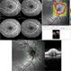 Optic Nerve Head Drusen Optic Nerve Head Drusen