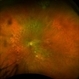Mucopolysaccharidosis Type III Mucopolysaccharidosis Type III