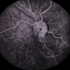 Autosomal Dominant Preretinal Vascular Loops Autosomal Dominant Preretinal Vascular Loops