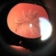 Traumatic Cataract and Iridodialysis, Retroillumination