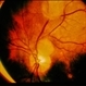 Tuberous Sclerosis Tuberous Sclerosis