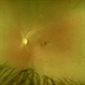 White and Red Spots- Roth Spots and Leukemic Infiltrates in Acute Myeloid Leukemia