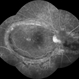 Permacular fold in Terson's syndrome Permacular fold in Terson's syndrome