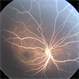 Lipemia Retinalis Lipemia Retinalis