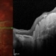 Macular Disciform Scar Macular Disciform Scar