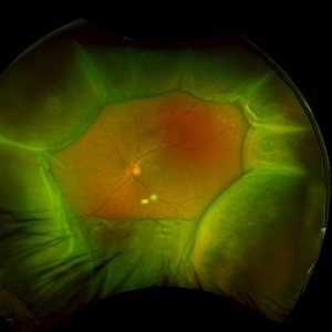 Idiopathic Uveal Effusion Syndrome - Retina Image Bank