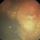Retinoblastoma Retinoblastoma