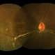 Spontaneously Attached Retina Spontaneously Attached Retina