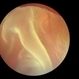 Retinal Dialysis (Superior) and Macula Off Detachment